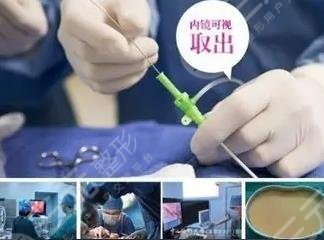 奧美定取出