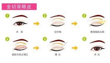 全切雙眼皮過(guò)程