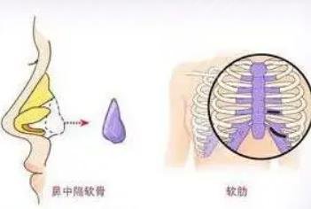 肋骨隆鼻三個月變化圖  　　1、手術(shù)前