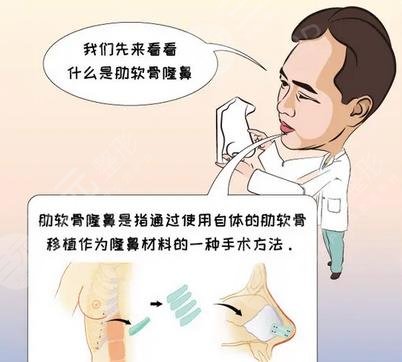 超肋骨鼻有哪些優(yōu)勢(shì)?