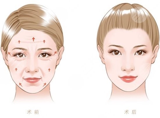 拉皮手術(shù)多大年齡做合適
