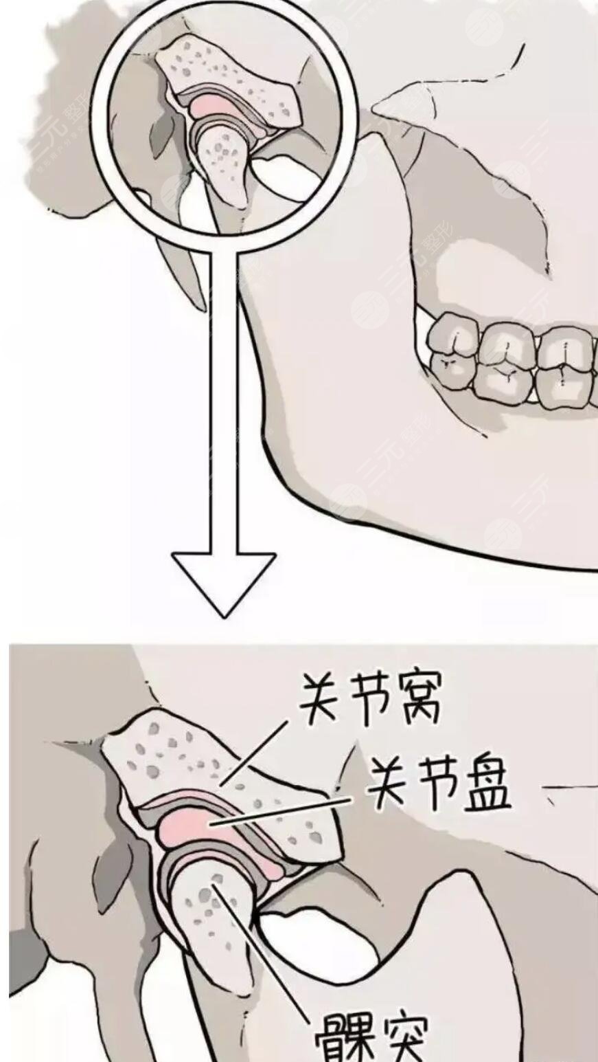 下顎骨太寬做手術(shù)多少錢