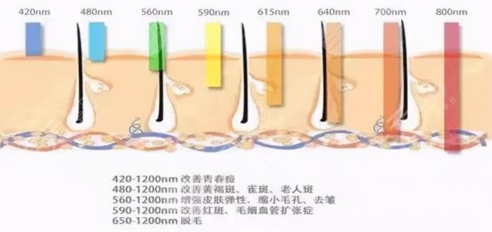 黑頭怎么去除有？激光去黑頭好處、注意事項(xiàng)等趕緊get上！