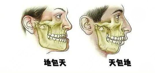 天包地矯正后臉型變化圖共享，矯正前的“如花”，矯正后的“側(cè)顏女神”~
