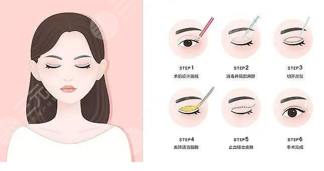 雙眼皮全切七天恢復(fù)圖過程細節(jié)記錄！國內(nèi)割雙眼皮醫(yī)院排行榜及價格表深度調(diào)查~