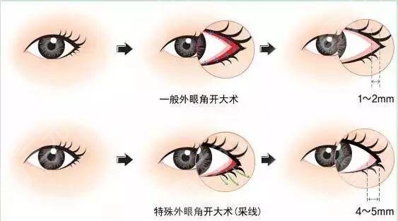 開外眼角圖片前后對比|恢復(fù)過程全覽