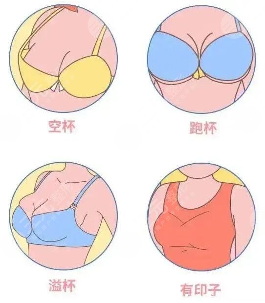 假體隆胸可以維持多久