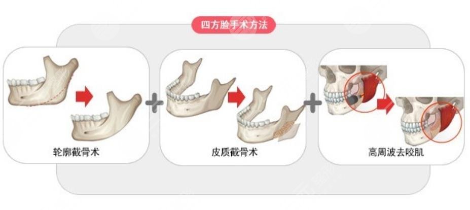 下頜角