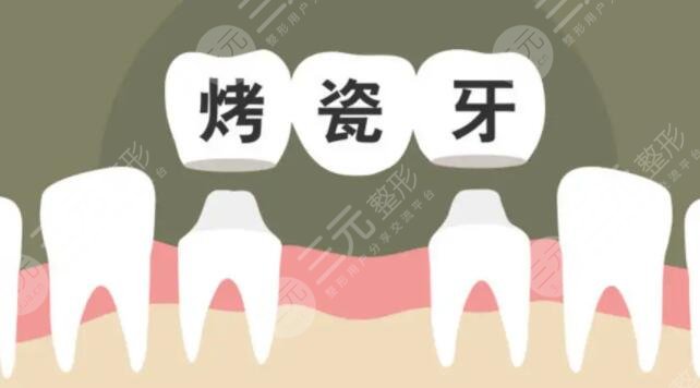 烤瓷牙多少錢一顆價格表2022全國，烤瓷牙壽命可以保持幾年？收藏不虧！