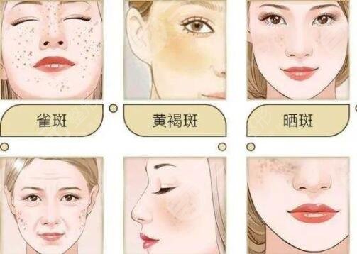 彩光祛斑的優(yōu)勢：