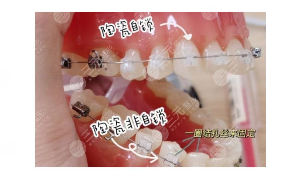 廣州柏德種植牙質(zhì)量和費(fèi)用怎么樣？