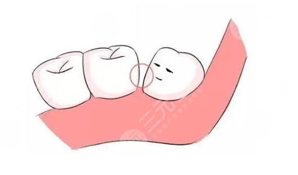 牙縫怎么修補