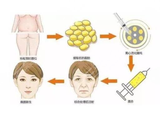 自體脂肪豐蘋果肌果好嗎