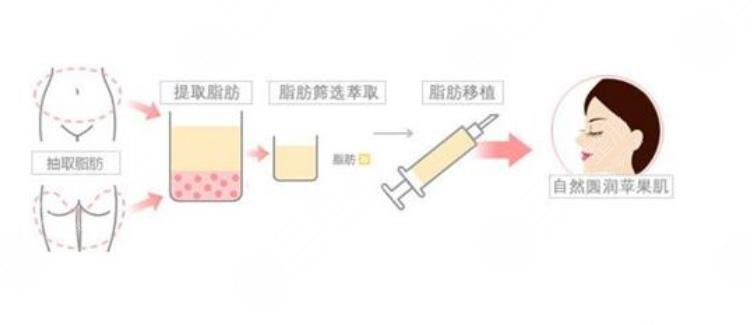 自體脂肪豐蘋果肌果好嗎