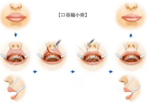 厚唇變薄手術(shù)多少錢？