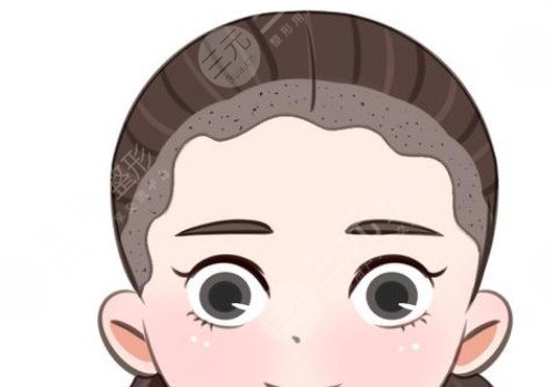 發(fā)際線移植能保持多久？