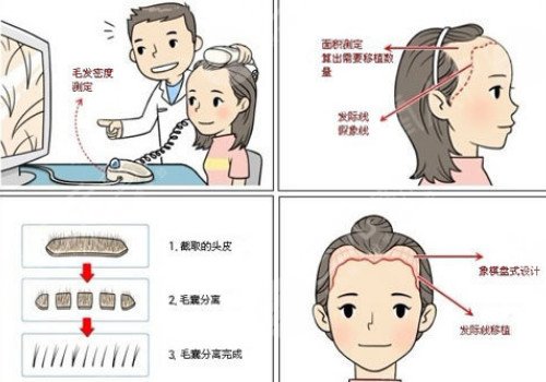 發(fā)際線移植能保持多久？