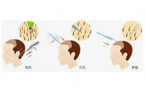 發(fā)際線移植能保持多久？
