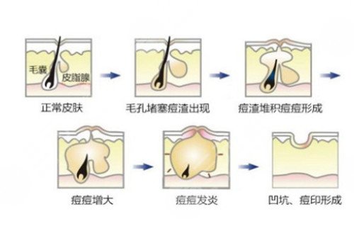 臉上長痘印如何消除?