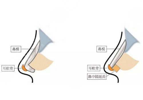自體軟骨隆鼻多少錢？