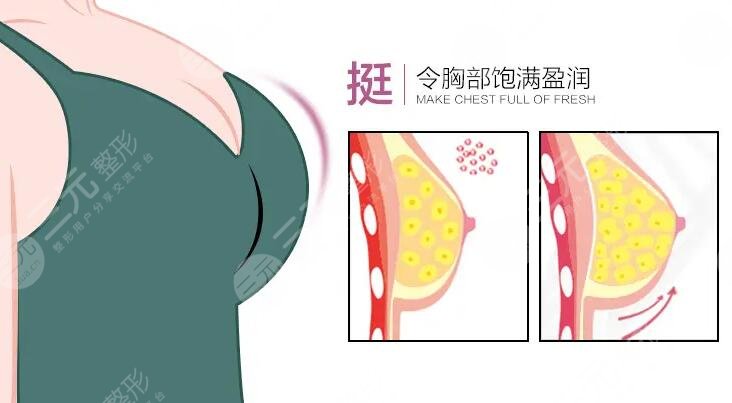 自體脂肪豐胸