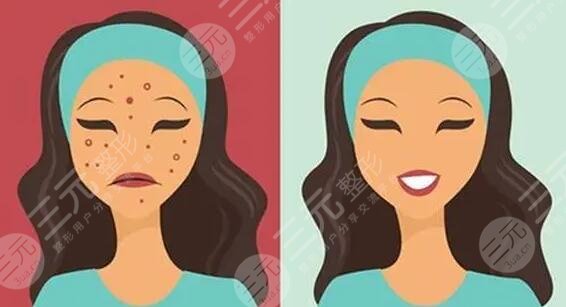 　　臉上的痘坑怎么去掉?隨著年齡的增長，不少人臉上都出現(xiàn)了青春痘或者是長痘的情況，這些多數(shù)是由內(nèi)分泌失調(diào)和皮膚油脂平衡失調(diào)造成的，首先在發(fā)現(xiàn)自己長痘之后，就需要通過正規(guī)的祛痘手術(shù)去除痘痘才行，如果是不正規(guī)的方法就容易造成痘坑、痘印，對于小伙伴們來說，痘坑痘印比痘痘更讓人難受，目前國內(nèi)可以去痘坑的方法有很多，都是國內(nèi)祛痘坑成功的小伙伴們選擇的技術(shù)手段，下面就有小編一一來為大家做一個介紹!  　　1、臉上的痘坑怎么去掉更有?  　　(1)、激光祛痘坑，利用高熱能量的激光，在皮膚表面進行照射，光能對痘坑位置有一定的刺激作用，能夠刺激膠原蛋白的再生和膠原纖維的修復(fù)生長，從而達到修復(fù)痘坑的果。  　　(2)、果酸換膚，果酸換膚主要是在痘坑皮膚表面涂抹果酸，利用專業(yè)的器械設(shè)備刺激手術(shù)部位的皮膚細胞再生，加速痘坑區(qū)域的新陳代謝來達到去除痘坑，讓皮膚看起來光滑平整的手術(shù)果。  　　(3)、微針緩解，微針緩解是很多美容院都會采取的一種改良痘坑的方法，能夠?qū)⒍豢游恢玫钠つw層次重新進行疏通，輸入一定的營養(yǎng)物質(zhì)，使皮膚的修復(fù)能力上線來達到去除痘印的果。  　　(4)、填充祛除，填充的技術(shù)手段所針對的是痘坑，比較嚴(yán)重的人群，特有的一種技術(shù)方法，將專業(yè)的填充材料填充到痘坑凹陷比較嚴(yán)重的位置來讓痘坑平整。  　　(5)、DIY面膜，如果是針對于痘坑比較淺或者是新出現(xiàn)的痘坑的話，可以通過護膚品等方式來讓自己的痘坑有一定的修復(fù)果，其中比較受求美者喜歡的是蛋清珍珠粉，面膜蛋清和珍珠粉融合之后涂抹在面部一5到20分鐘左右，用清水清洗一周敷兩次左右，一段時間之后可以有一定淡化痘坑的果。  　　2、激光祛痘印痘坑多少錢?  　　激光去除痘坑痘印的價格通常在2千到一萬元不等，首先緩解面積是影響價格的關(guān)鍵，如果是小面積的痘坑，那么它的手術(shù)難度就比較小，費用也會比較便宜，但如果是面積較大且又深的痘坑的話，那么它的收費價格就會在8000元及以上。當(dāng)然醫(yī)院的選擇和地區(qū)的選擇也會影響到價格，3甲醫(yī)院的收費要比2甲醫(yī)院更貴，私立的整形醫(yī)院和普通的門診部的收費標(biāo)準(zhǔn)也有一定的區(qū)別，一線城市和3線城市的醫(yī)療標(biāo)準(zhǔn)也有較大的不同。除了以上兩點以外醫(yī)生的選擇其實也會影響到價格收費情況，實習(xí)醫(yī)生和的祛痘坑醫(yī)生，它的收費標(biāo)準(zhǔn)都是不一樣的。  　　3、激光去痘坑要做幾次?  　　一般情況下，激光去痘坑要做3到5次時間，它主要是通過皮膚表層深入到皮膚層，為此促進皮膚膠原蛋白的再生來改良痘坑問題，但每一個人的實際情況是不一樣的，如如果是痘坑比較淺的求美者的話。那么他的激光祛痘坑3次就可以有良好的改良果，反之則要五次。  　　4、微晶磨皮和點陣激光哪個比較好?  　　這之間都是激光的一種，都可以運用到去除疤痕，去除痘坑，去除皺紋，上面不同點在于兩者所使用的材料是不一樣的點，點陣激光采用的是超脈沖和激光掃描，兩者結(jié)合在一起，微晶磨皮則采用的是氫化硅晶體，作為求美者，建議可以直接到醫(yī)院，讓醫(yī)生根據(jù)你的實際情況給你定制相對應(yīng)的美容方法，這樣才能有良好的祛痘坑果。