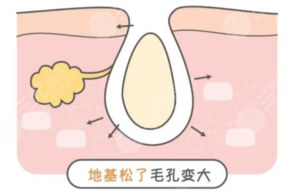 怎么收縮面部毛孔有又快速？文中3中方法你得學起來！如何預(yù)防是關(guān)鍵！