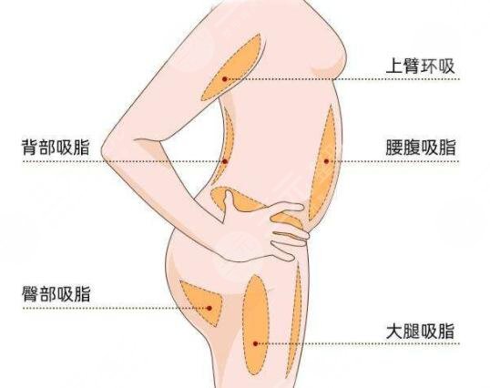五度吸脂后需要注意什么？