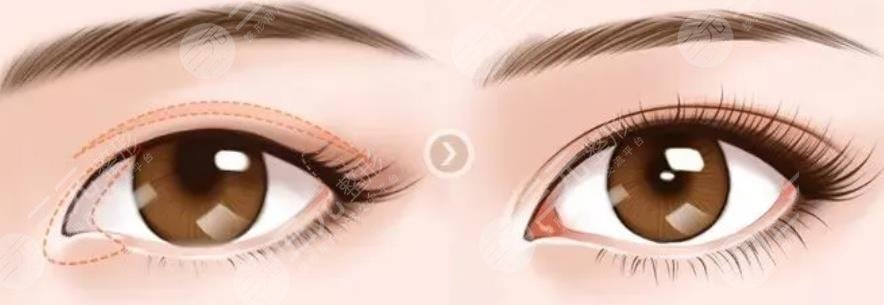 開(kāi)眼角