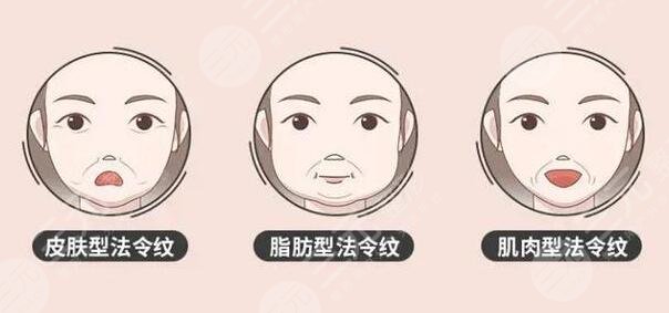 法令紋手術(shù)價(jià)錢一般多少錢？