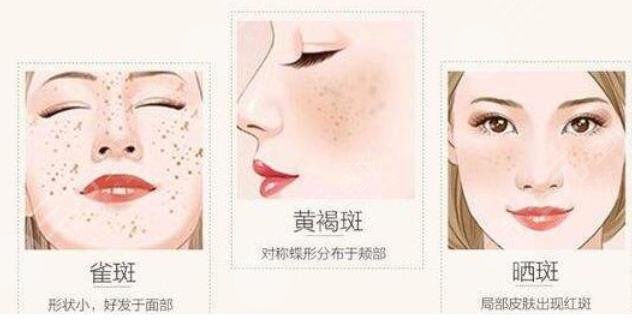 黃褐斑怎么淡化