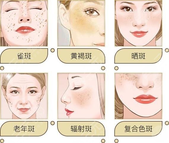 黃褐斑怎么淡化