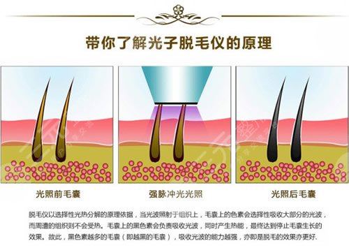 醫(yī)美脫毛方法