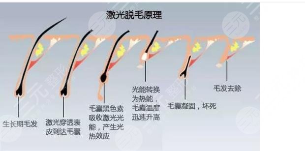 激光脫毛對身體有沒有傷害?