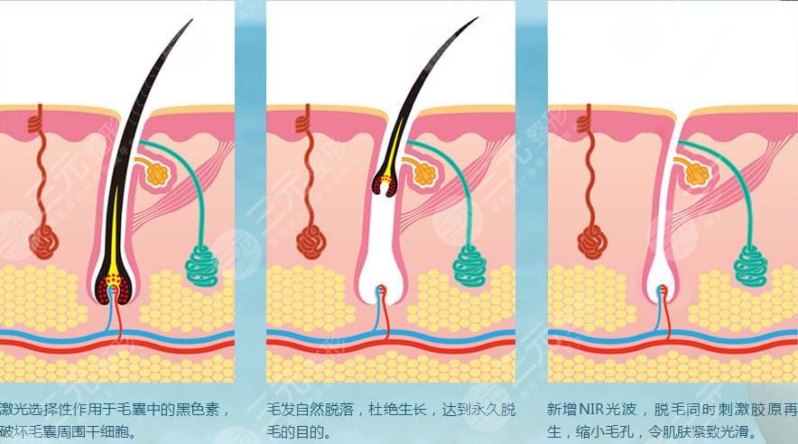 激光脫毛對身體有沒有傷害?