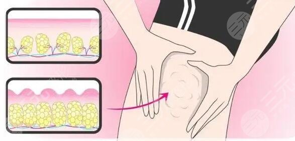 醫(yī)美整形上的塑性方式