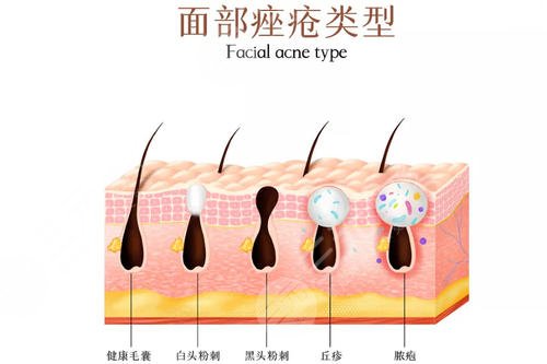 紅光緩解痤瘡幾次見(jiàn)?