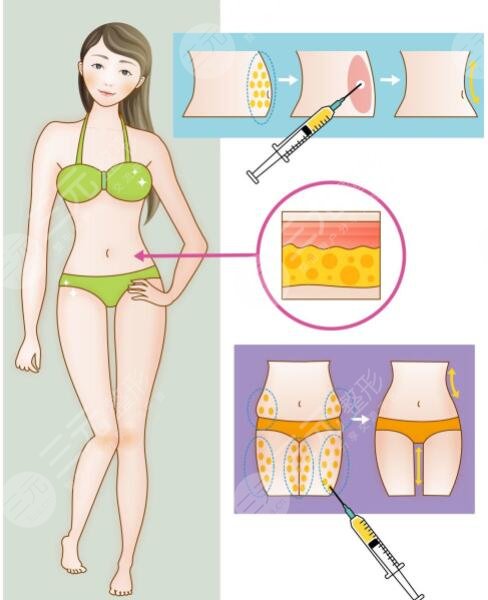 等離子激光溶脂有危害嗎？對(duì)身體有傷害嗎？副作用是什么？怎么果？