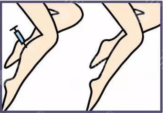 瘦小腿有的方法有哪些？見快且操作簡(jiǎn)單的方案，長(zhǎng)期堅(jiān)持果驚艷~