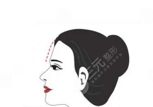 額頭窄豐額頭要多少錢(qián)?