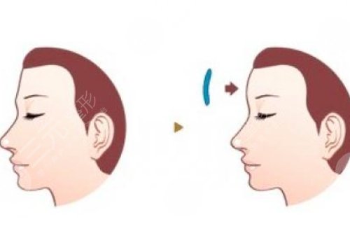 額頭窄豐額頭要多少錢(qián)?
