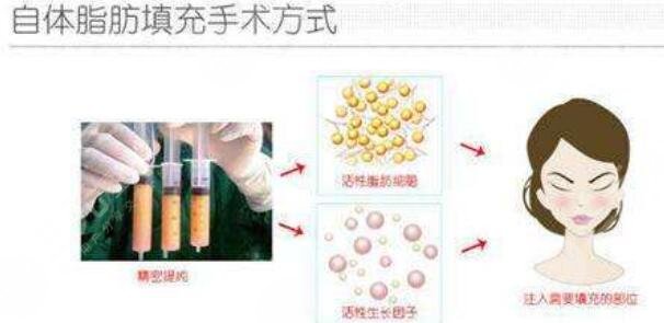 全臉脂肪填充的優(yōu)勢(shì)