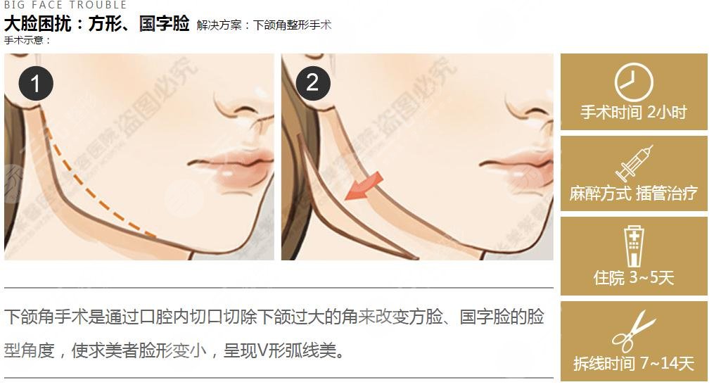 下頜角肥大怎么樣瘦?