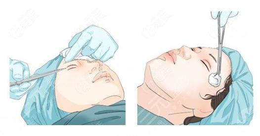 腫眼泡吸脂手術(shù)注意事項(xiàng)?