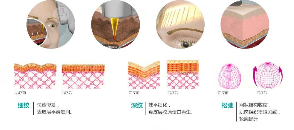 復(fù)合彩光緩解多少錢(qián)？
