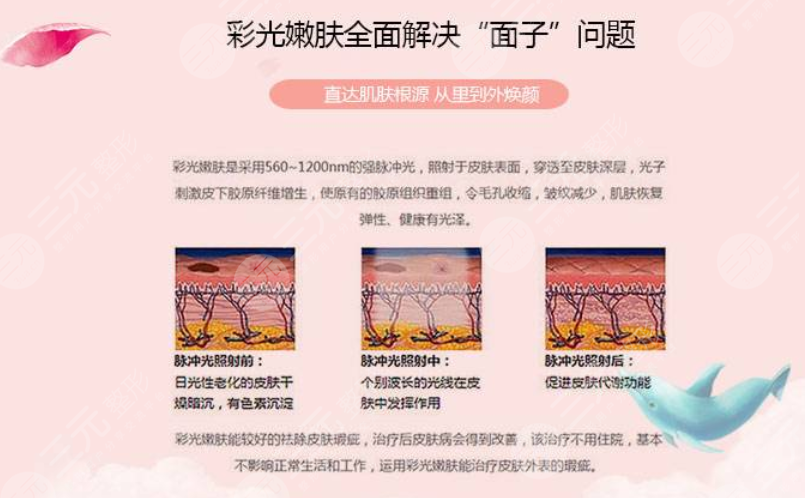 復(fù)合彩光緩解多少錢(qián)？