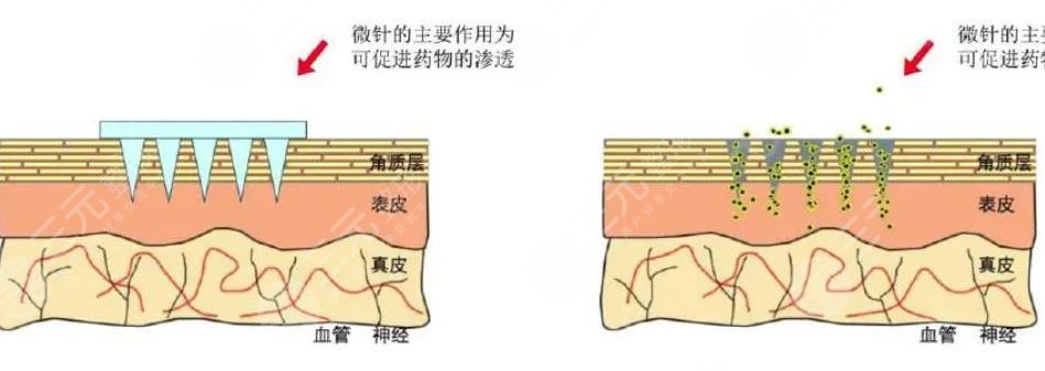 微針