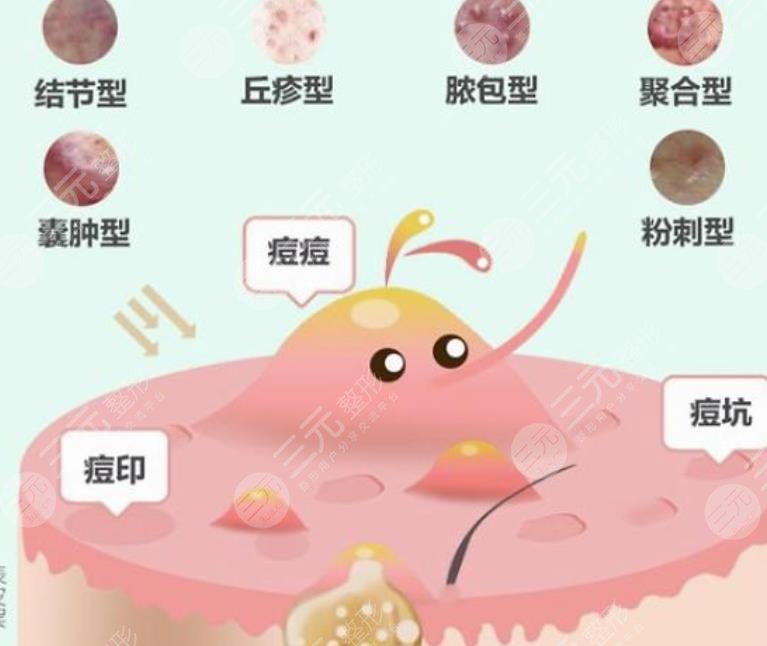 長痤瘡