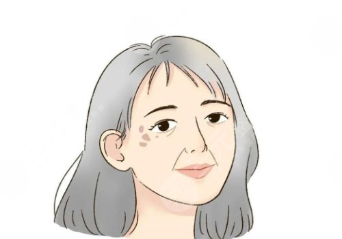 怎樣治老年斑？