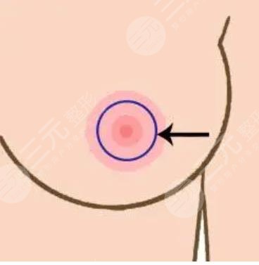 乳暈縮小